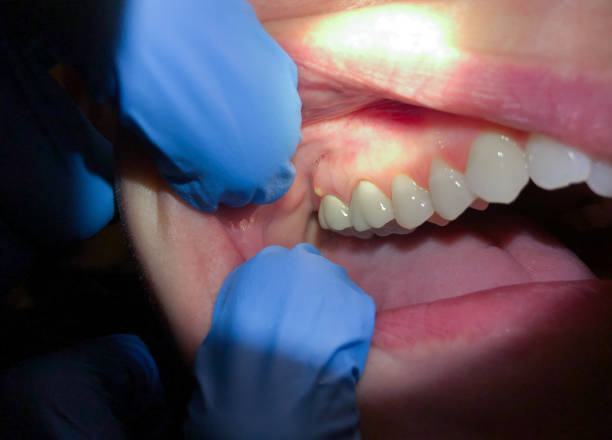 Best Broken or Cracked Tooth Emergency Dentist in Marysville, OH