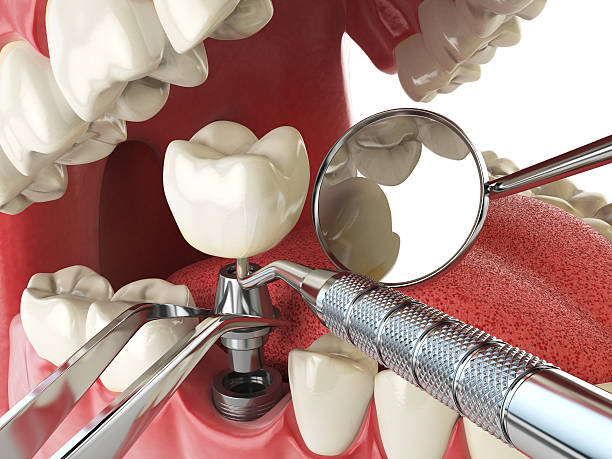 Best Broken or Cracked Tooth Emergency Dentist in Marysville, OH